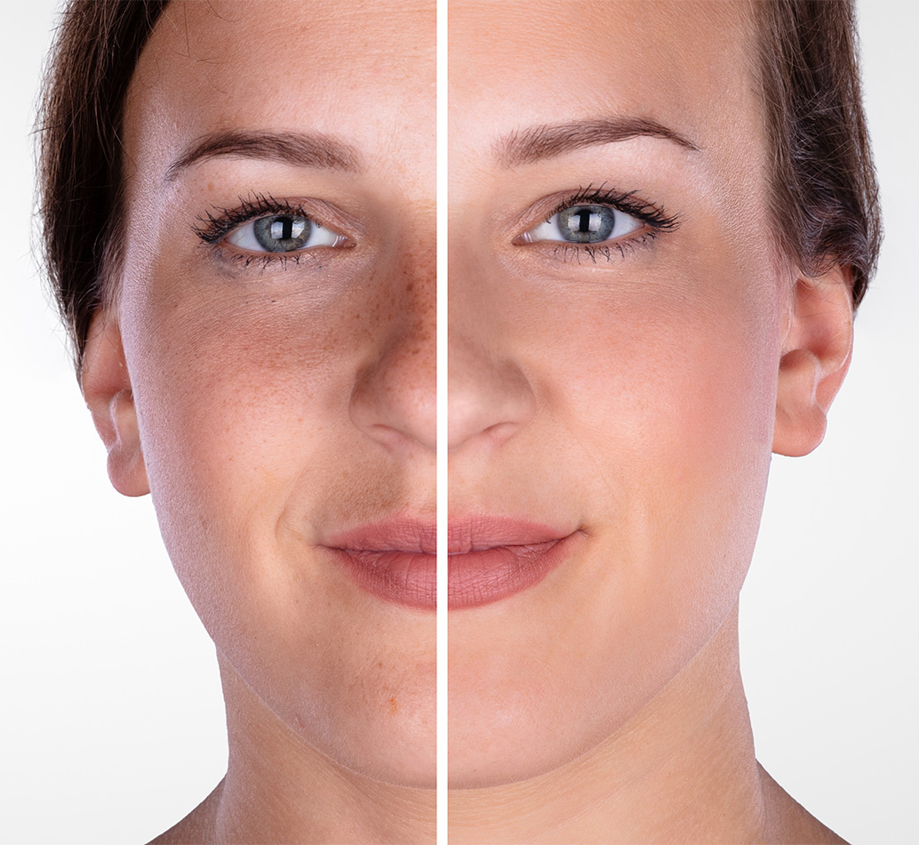 Microdermabrasion - Before and After